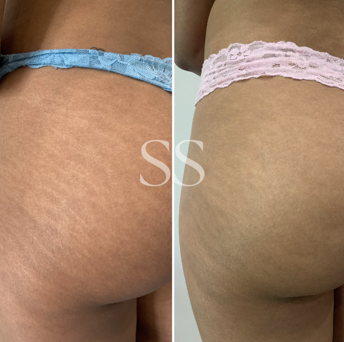 Before and after stretch mark camouflage on hip