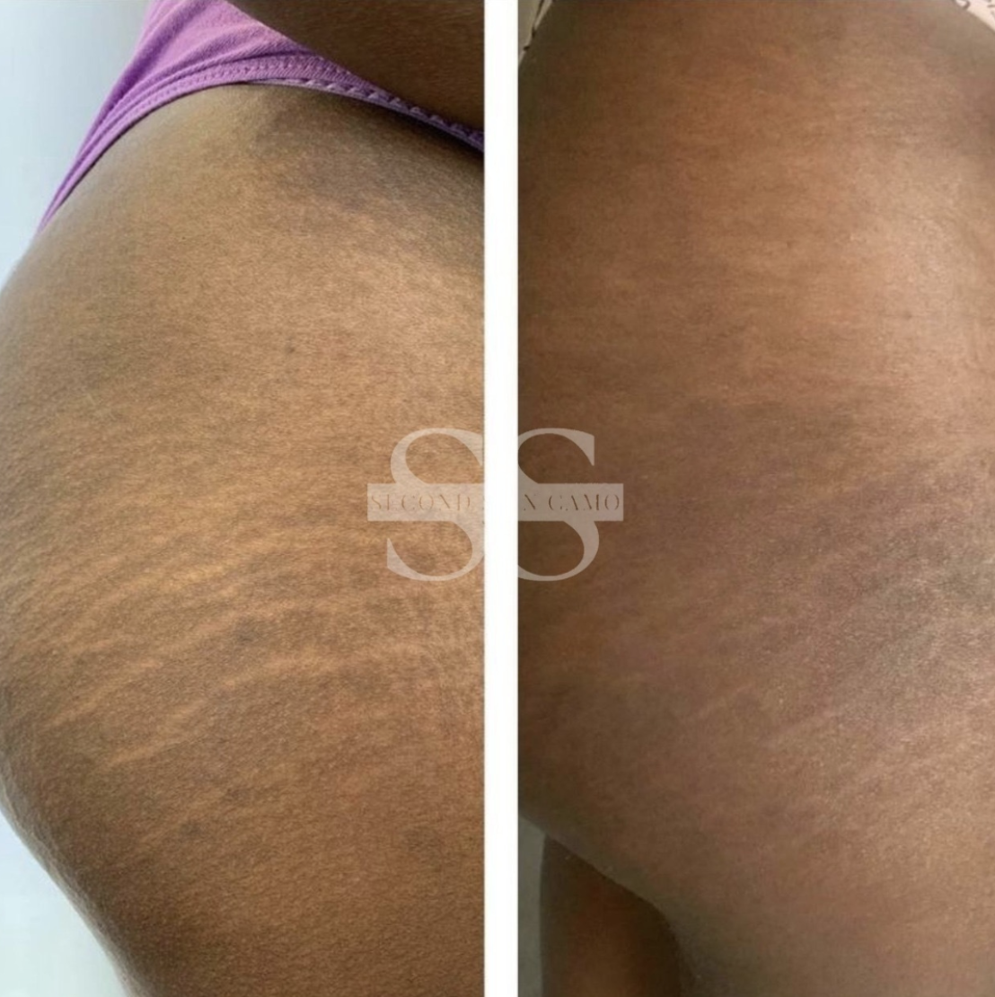 Before and after stretch mark camouflage on thigh