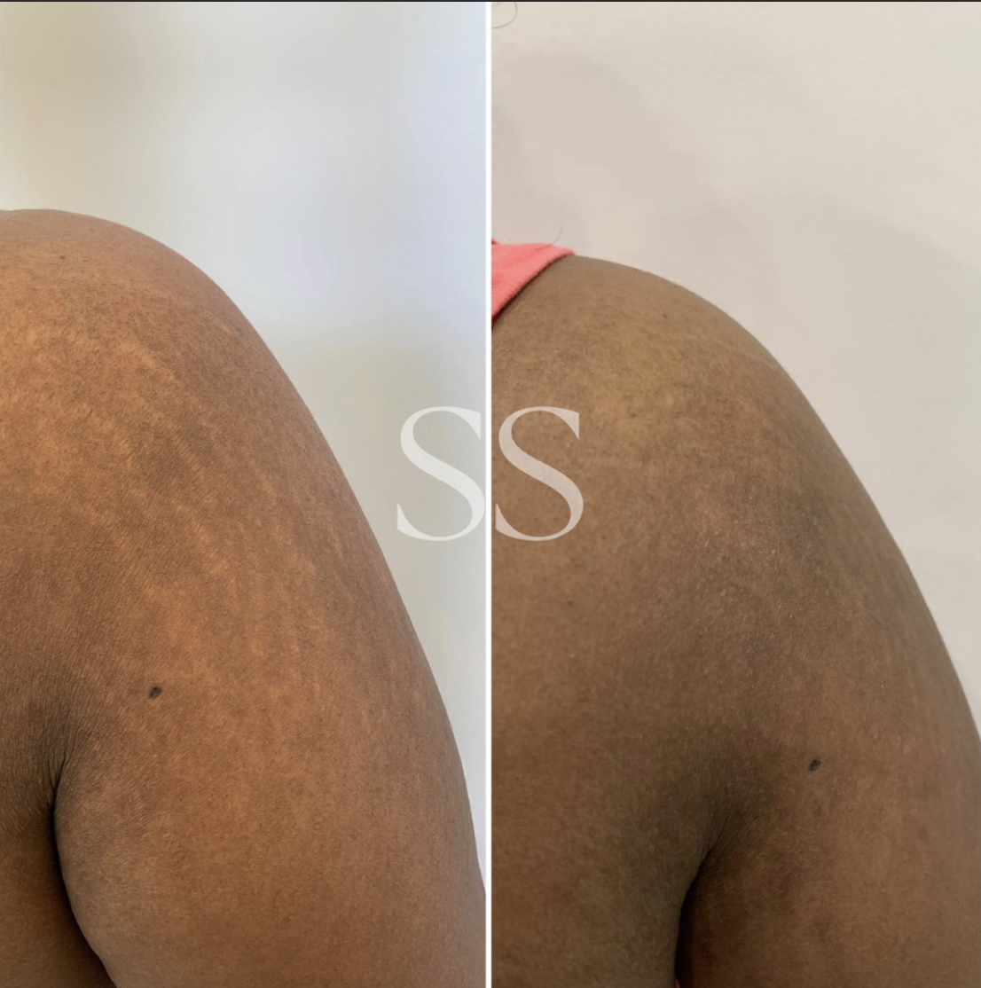 Before and after surgical scar camouflage