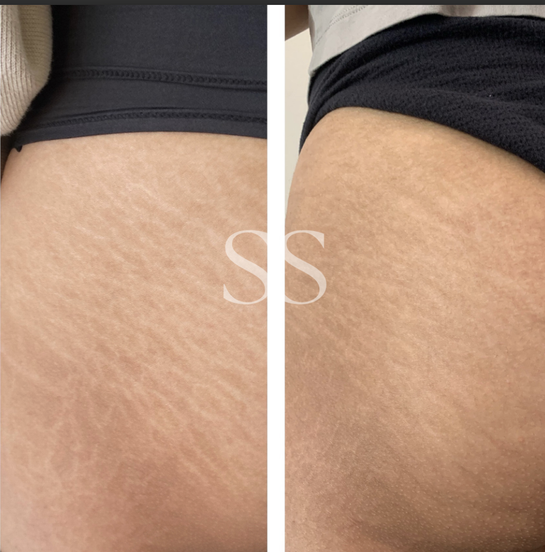 Before and after stretch mark blending