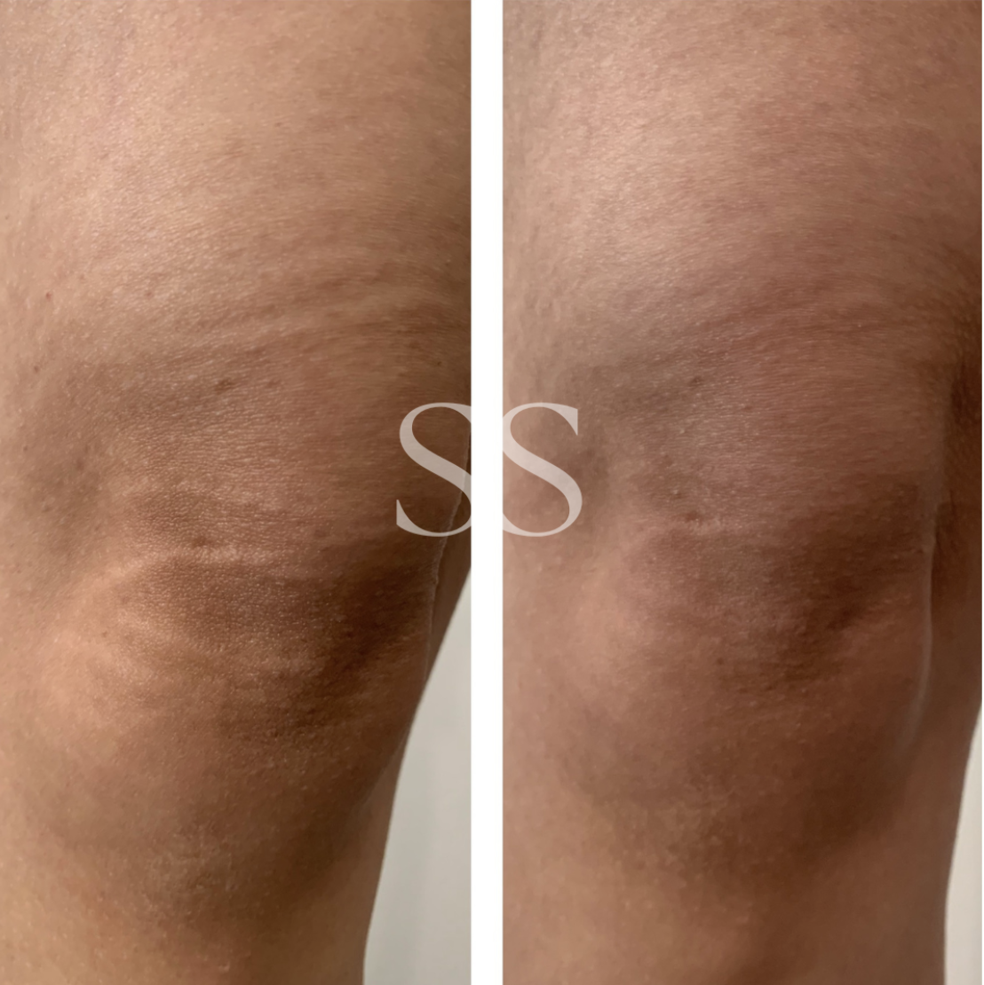 Before and after paramedical tattoo result